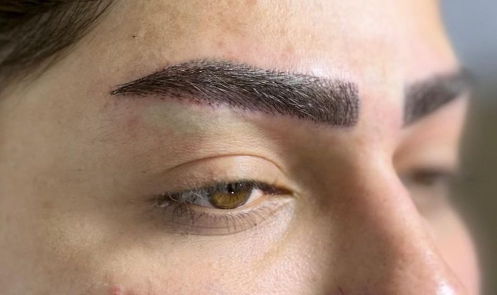 Eyebrow Transplant Work