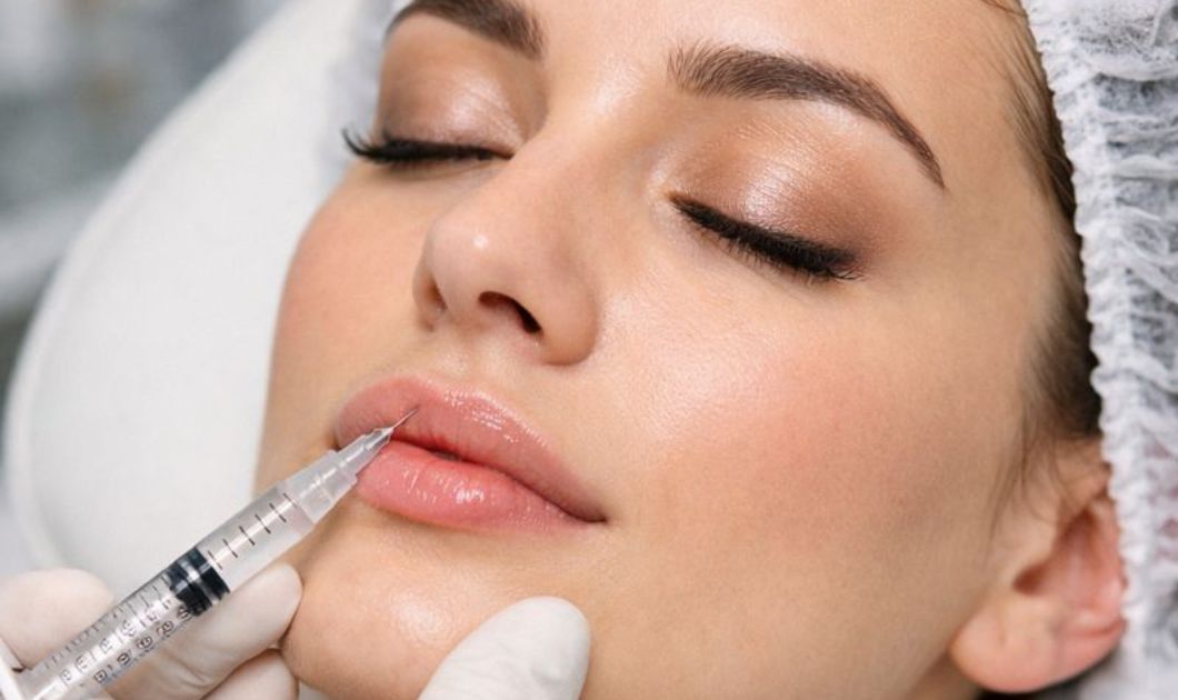 Lip Fillers
