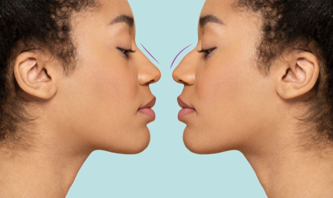 Rhinoplasty