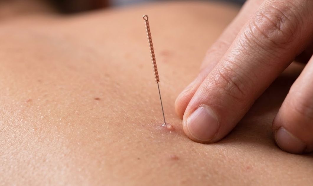 Dry Needling