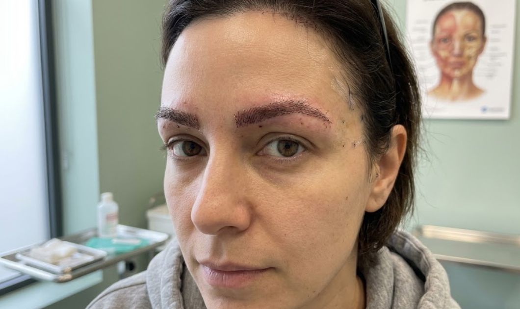 Eyebrow Transplant