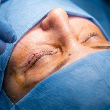 Lower Eyelid Blepharoplasty