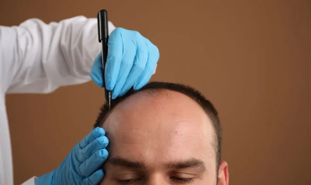 Hair Transplant Cost in Dubai