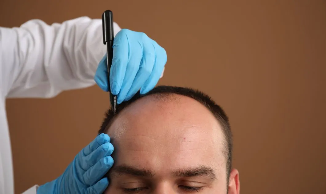 Hair Transplant Cost in Dubai