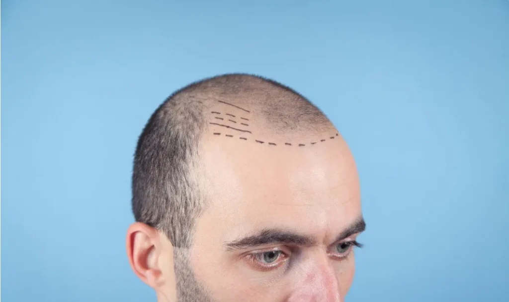 Hair Transplant Recovery