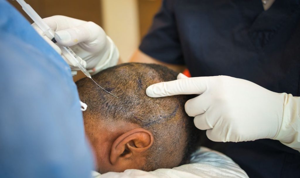 Hair Transplant in Dubai