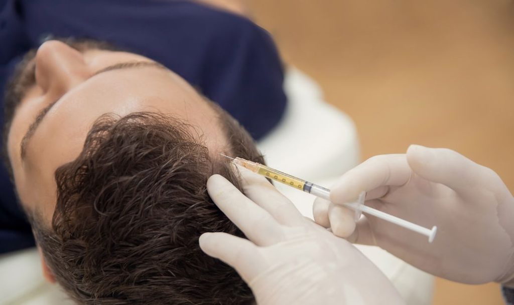PRP for Hair Loss