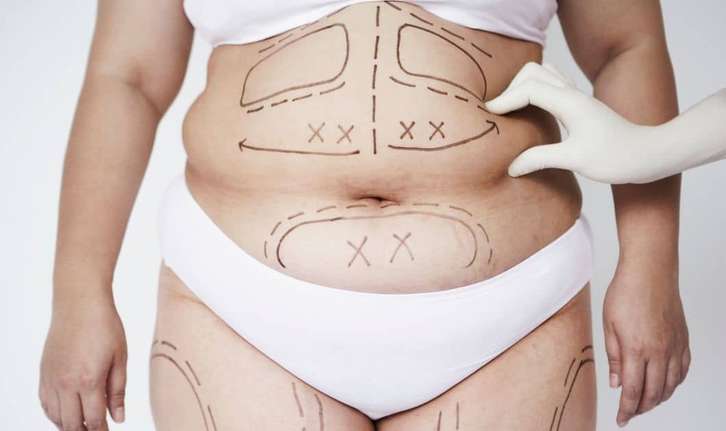 Trusta 360 Liposuction in Dubai - Full Body Contouring