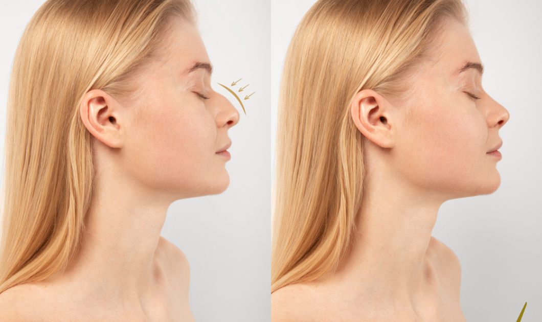 Before and After Endolift