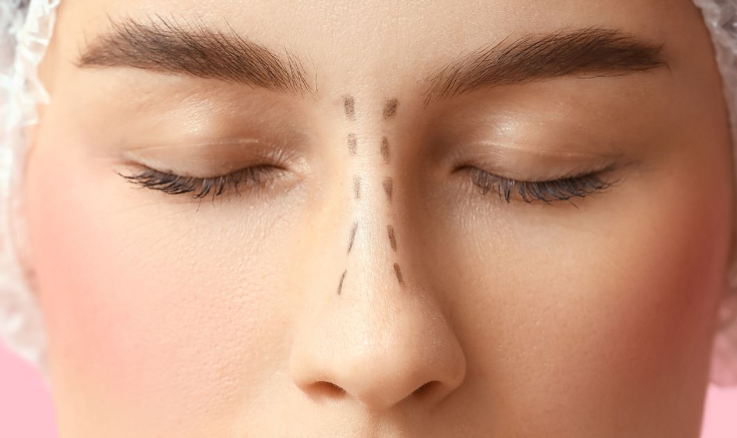Rhinoplasty In Dubai: Transform Your Look Safely - Trusta Clinic