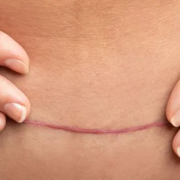 Cesarean Section