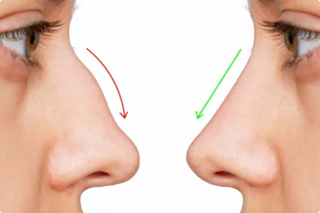 Rhinoplasty Dubai Before and After