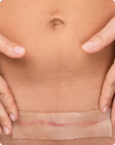 Wound Care After C-Section