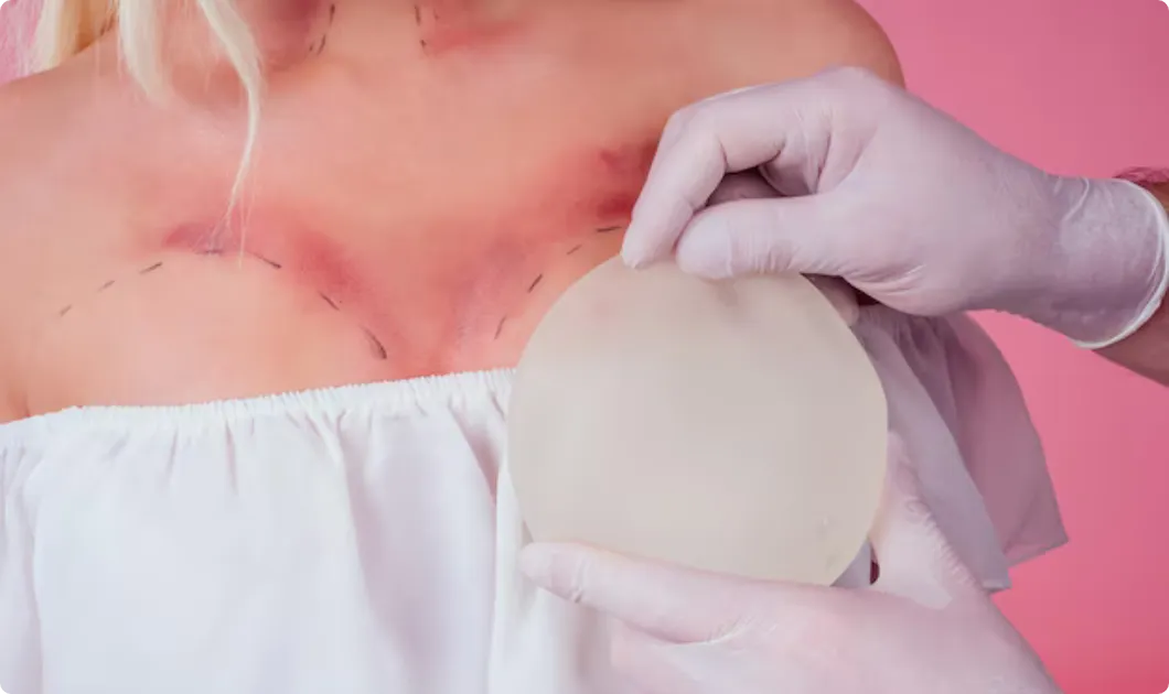 breast augmentation scars