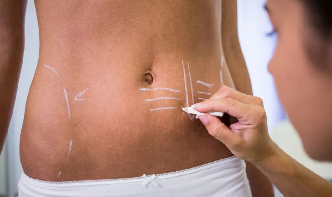Areas That Can Be Treated With Liposuction in Dubai