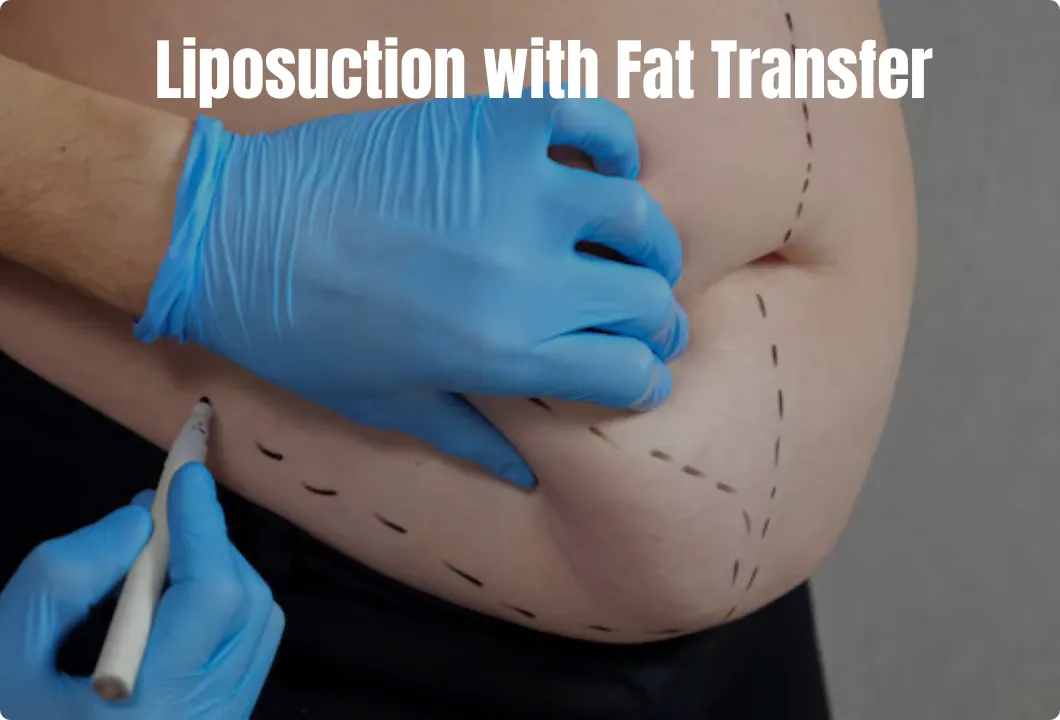 Liposuction with Fat Transfer