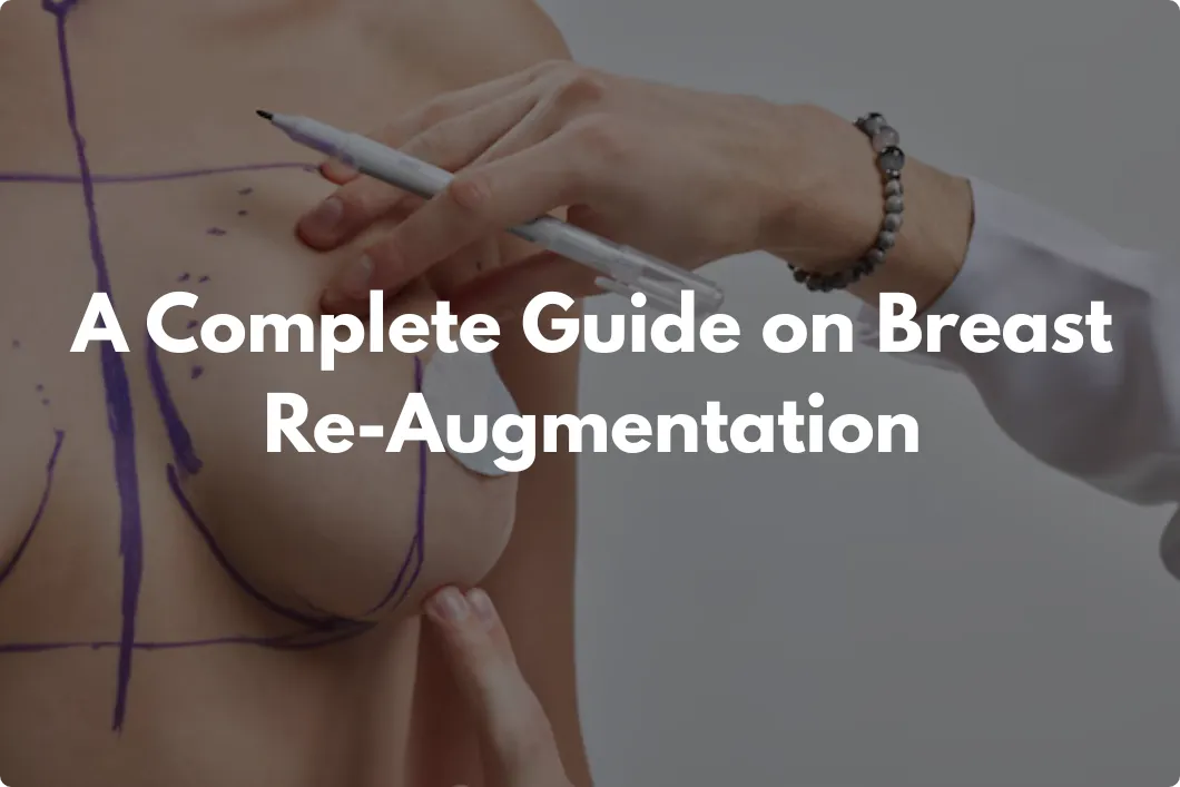 breast re-augmentation