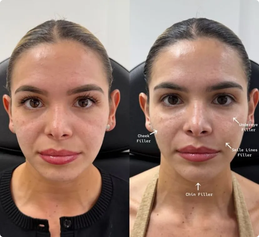 Cheek fillers before and after