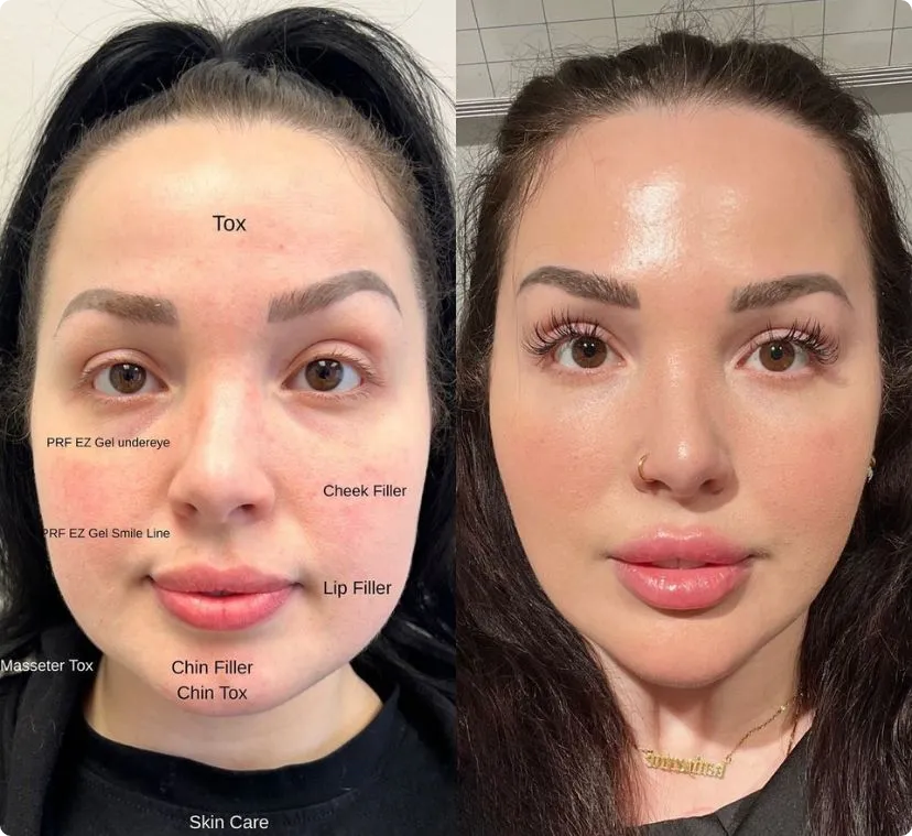 Cheek fillers before and after