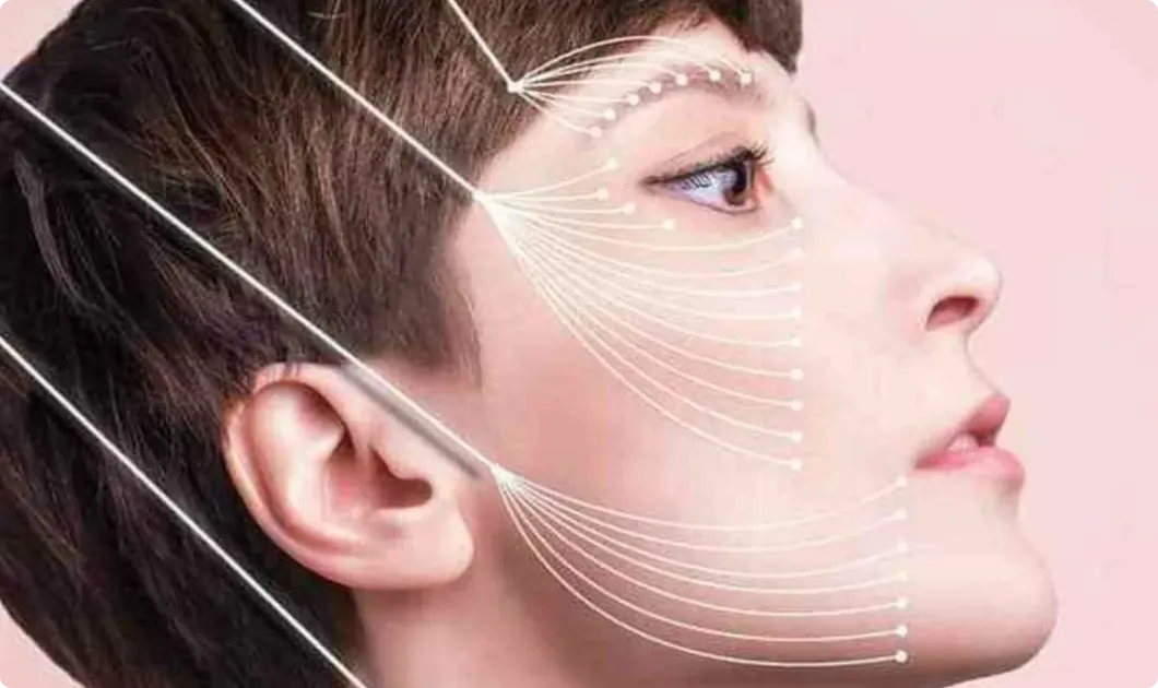 Side profile of a woman illustrating thread lift placement along the forehead, cheeks, and jawline.