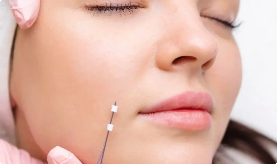 Thread lift