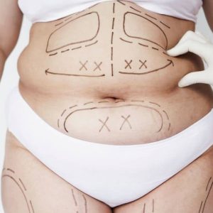 360 Liposuction