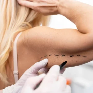 Arm Liposuction in Dubai
