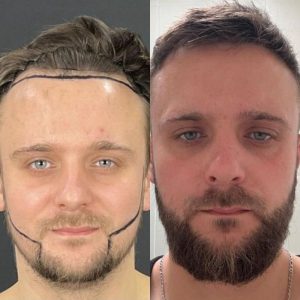 Beard Transplant Before & After Results Gllary