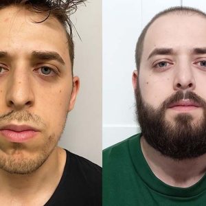 Beard Transplant Before & After Results