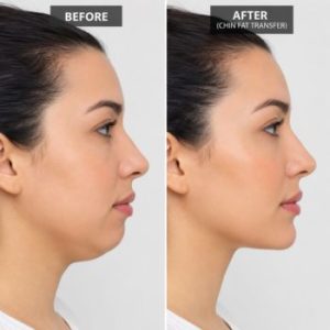 Before and After Chin fat transfer