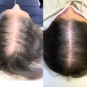 Hair Restoration Before and After Results