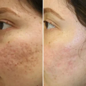 Before and after treatment for pitted acne scars