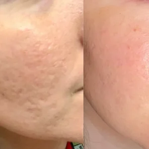 Before and after treatment for pitted acne scars