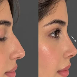 Benefits of Revision Rhinoplasty