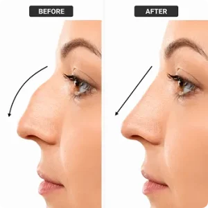 Benefits of Rhinoplasty