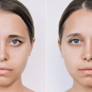 Blepharoplasty (Eyelid Surgery)