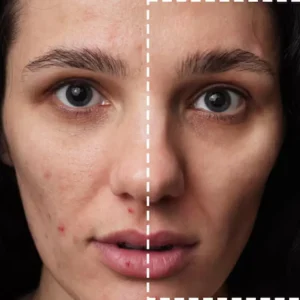 Carbon laser facial Dubai
