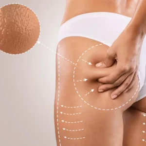 Cellulite Silhouette