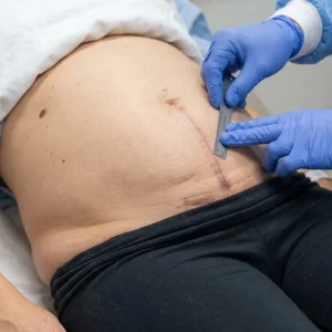Cesarean Scar Assessment