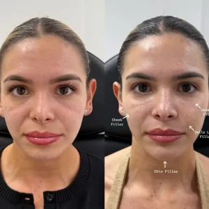 Cheek fillers before and after