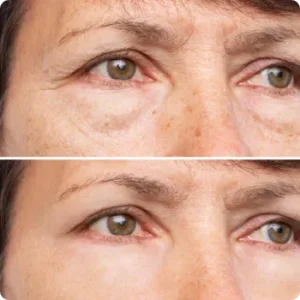 Cosmetic Blepharoplasty
