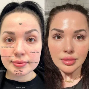 Cheek fillers before and after