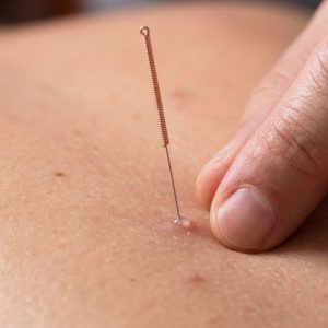 Dry Needling