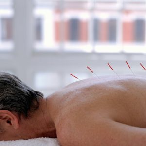 Dry Needling
