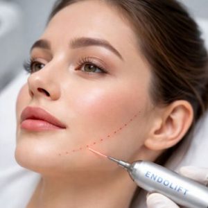 Endolift