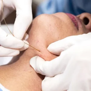 Eufoton Endolift machine treatment at Trusta Medical Center in Dubai