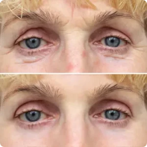 External Lower Blepharoplasty