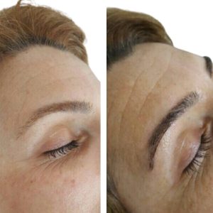 Eyebrow Transplant Result