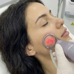 smoother skin texture after laser sessions