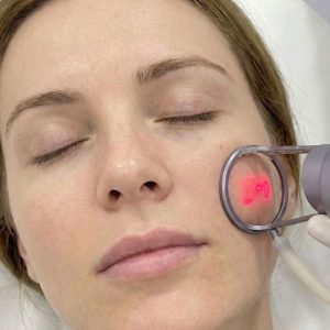 Fotona 4D for Wrinkles